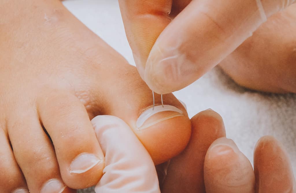 Find a Skilled Podiatrist in Edinburgh for Foot Pain and Nail