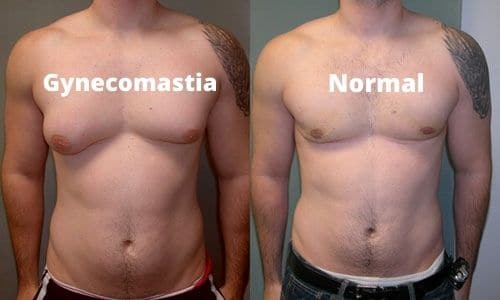 Male chest fat surgery Islamabad