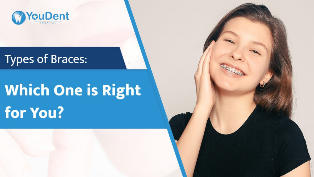 Types of Braces Which One is Right for You