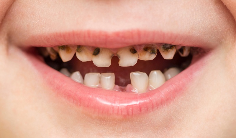 Cavities